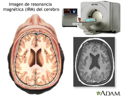 Representación gráfica de IRM del Cerebro